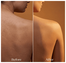 Before/After Back